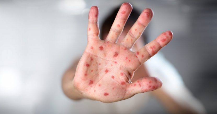 Большинство летальных случаев от кори было у детей — Биртанов