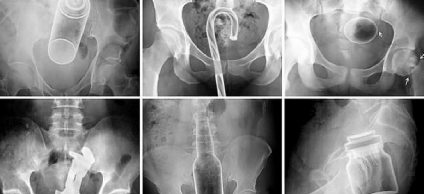 Хирурги рассказали, какие предметы они извлекали из людей