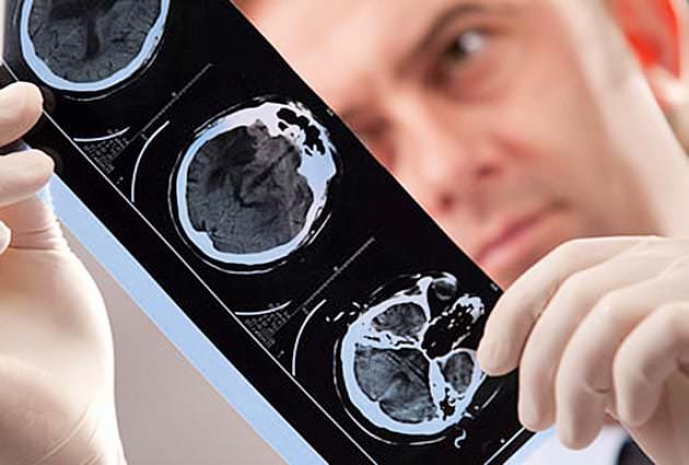 Ученые раскрыли связь между раком мозга и уровнем сахара в крови