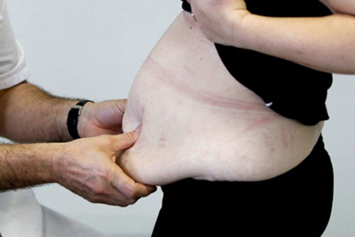 Полмиллиона случаев рака в год оказались связаны с ожирением