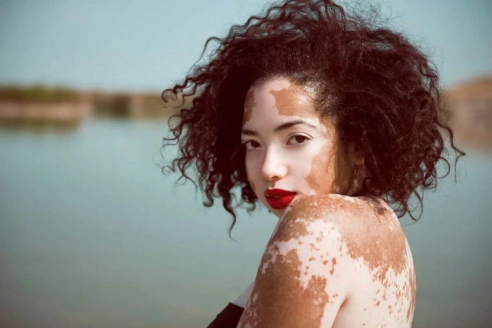 Всемирный день витилиго, независимости Мозамбика и единения славян