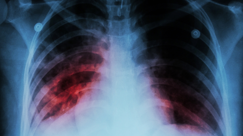 Заболеваемость туберкулезом среди осужденных снизилась в 4 раза — КУИС