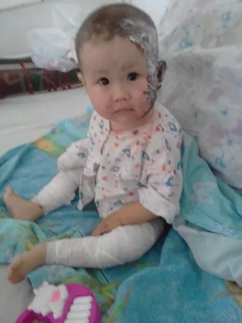 Семье, пострадавшей при пожаре, срочно требуется помощь на лечение детей