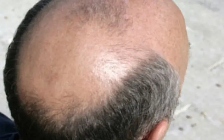 Низкорослые мужчины раньше лысеют – ученые