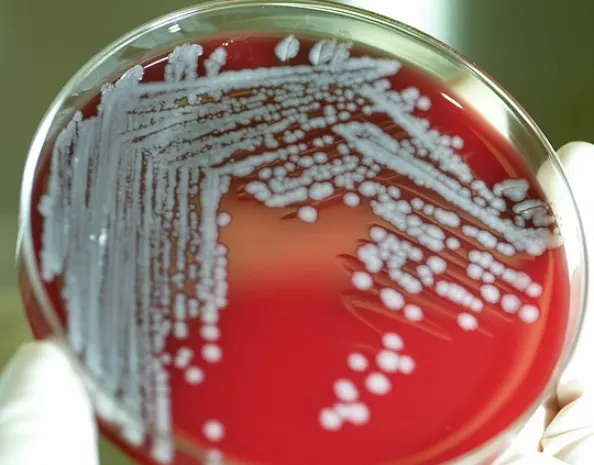 В ВКО скончался пациент с подозрением на сибирскую язву