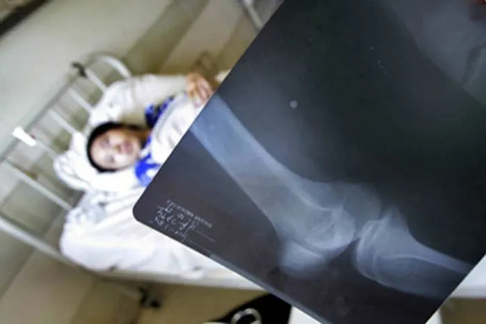 Антропологи объяснили хрупкость костей человека