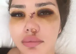 Сломал нос и угрожал обрезом: девушку избили на пляже в Актау