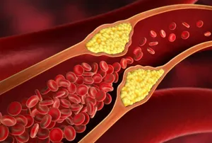 Холестерин жоғарылағанын қандай белгілер көрсетеді – терапевт