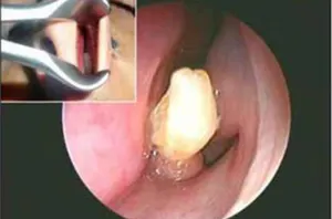 В Саудовской Аравии стоматологи удалили зуб из носа пациента