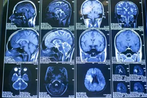 Скончался человек с оживленным мозгом