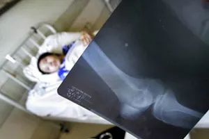 Антропологи объяснили хрупкость костей человека