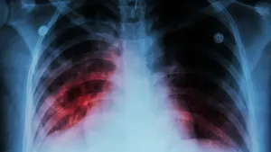 Школьники заразились туберкулезом в Актау