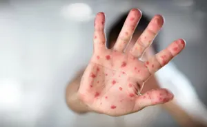 Сезон заболеваемости корью завершается в Нур-Султане