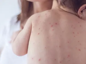 Вспышка кори в Атырауской области идет на убыль