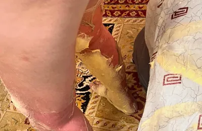 Ребенок получил сильные ожоги в Актау