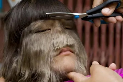 «Синдром оборотня» поражает детей в Испании