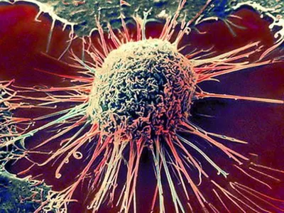 В Казахстане хотят сэкономить на раковых больных