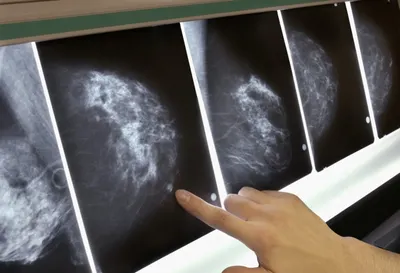 Рак груди при помощи искусственного интеллекта научились выявлять в России