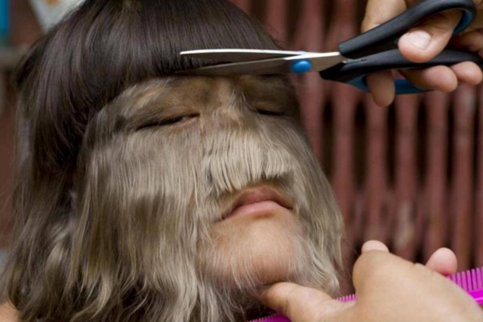 «Синдром оборотня» поражает детей в Испании