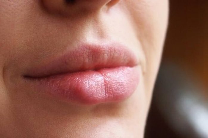 Как лечить герпес и что следует о нем знать