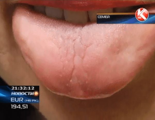 У жительницы Семея на языке появилась надпись «Аллах»