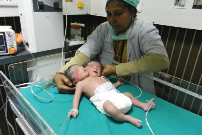 Девочка с двумя головами родилась в Индии