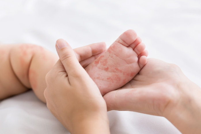 Более 17 тысяч случаев кори зарегистрировано в Казахстане