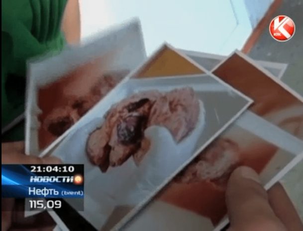 22 года казахстанец жил с человеческим зародышем в желудке