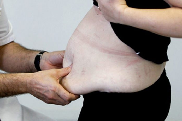 Полмиллиона случаев рака в год оказались связаны с ожирением