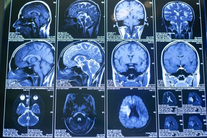 Скончался человек с оживленным мозгом