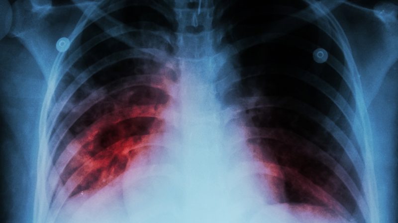 Легочной чумой заразились два человека в Китае