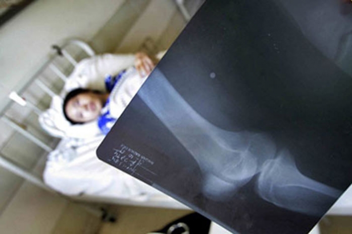 Антропологи объяснили хрупкость костей человека