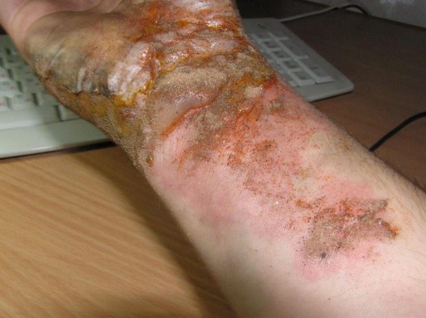 В Павлодарской области скончался мужчина, обварившись кипятком